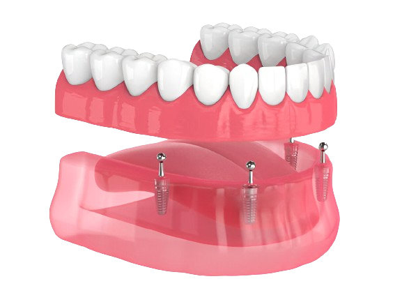 Image of Denture